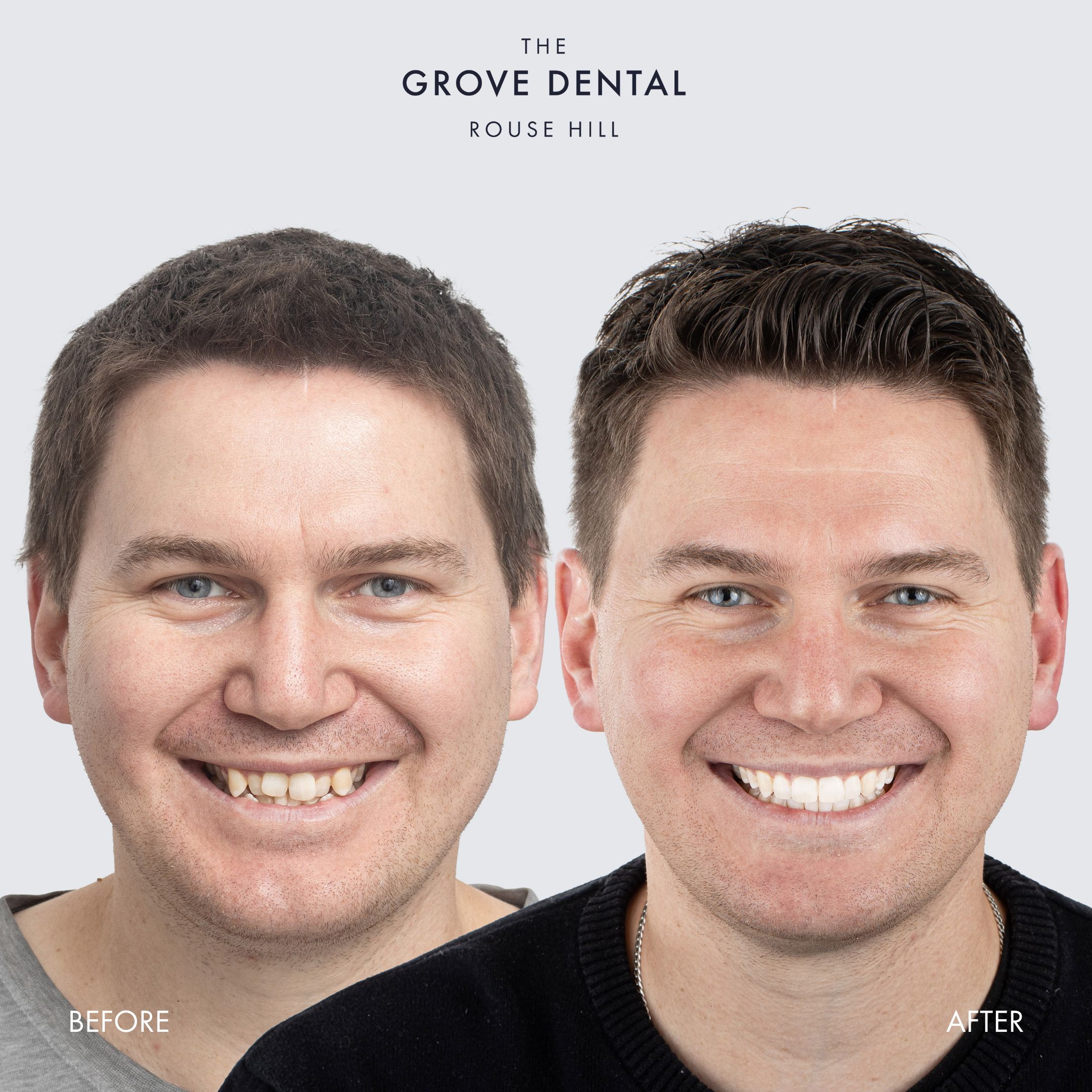 Martin — Clear Aligners
