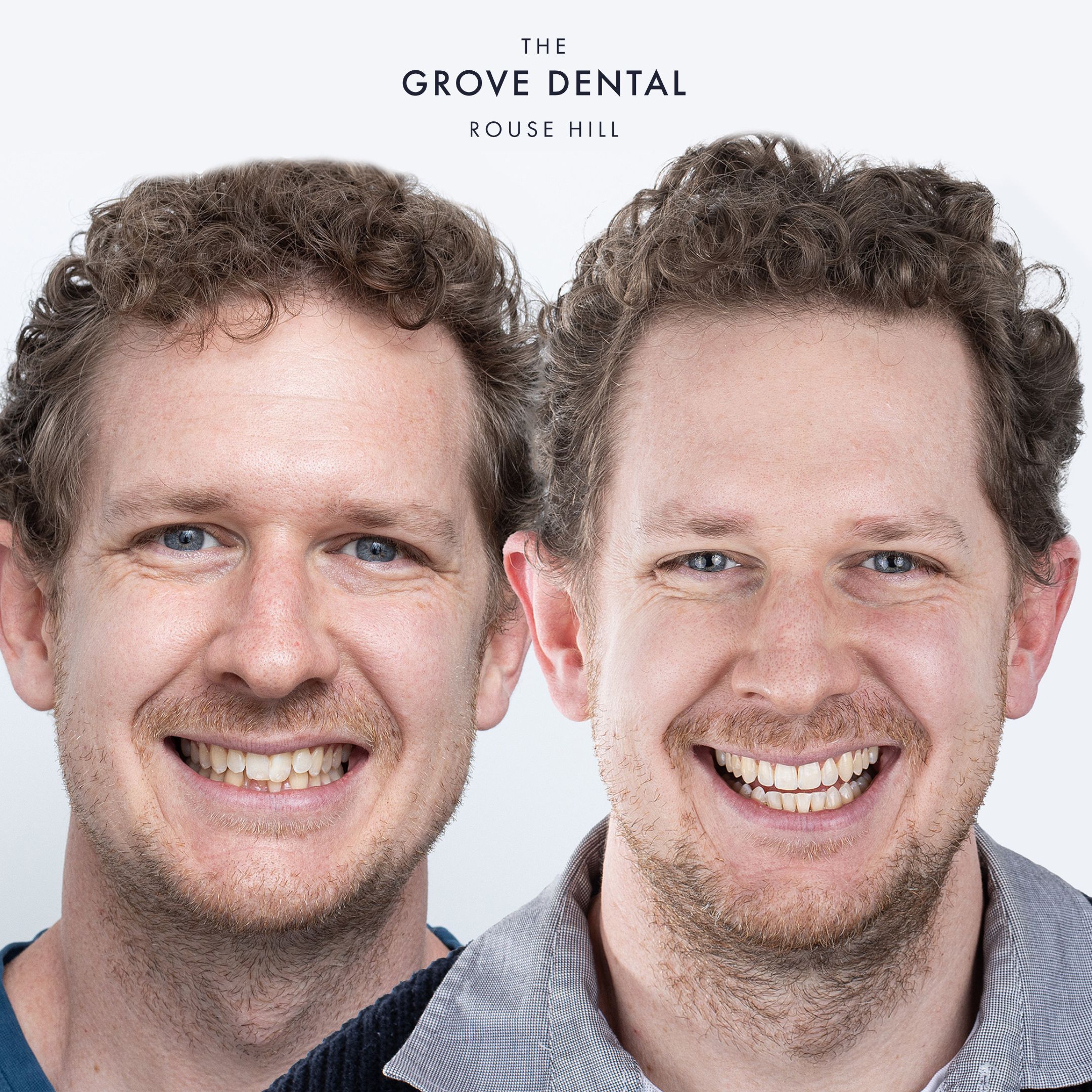 Sam — Clear Aligners