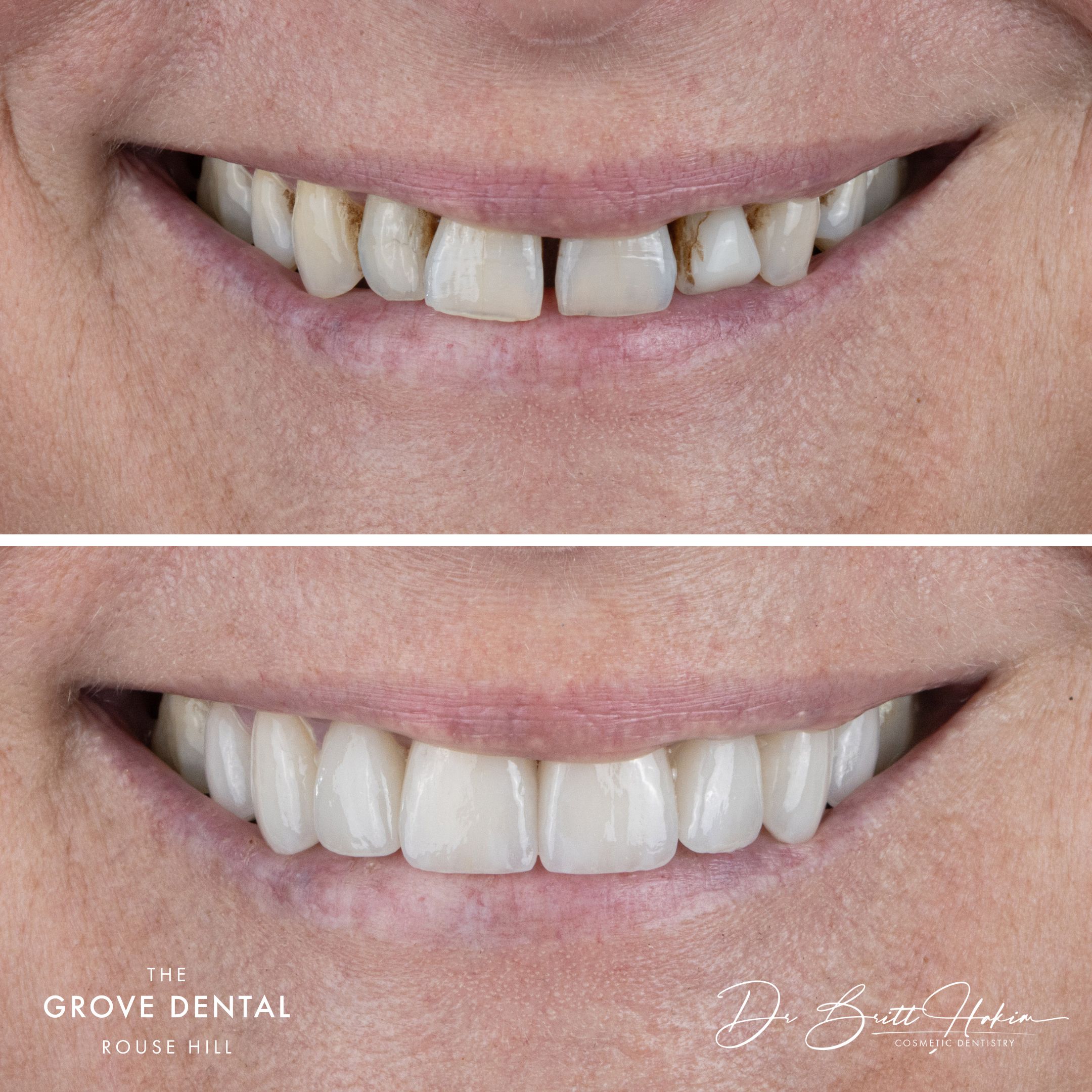 Clear aligner smile alignment — before close-up at The Grove Dental