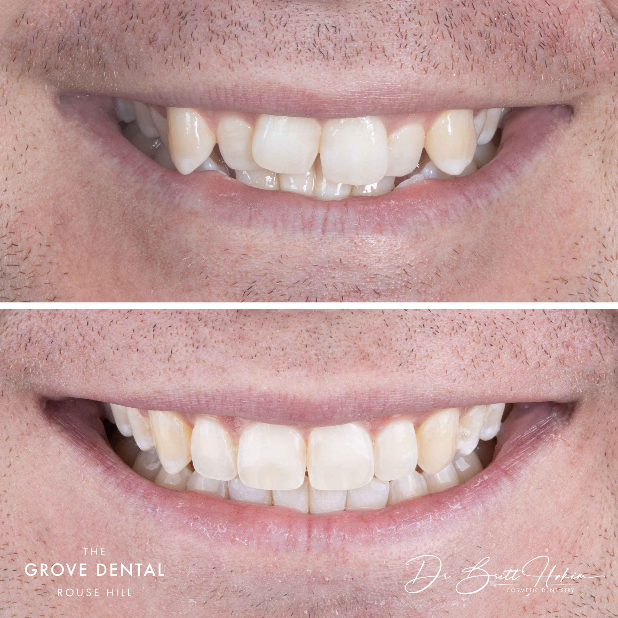 Clear aligner smile makeover — before close-up at The Grove Dental
