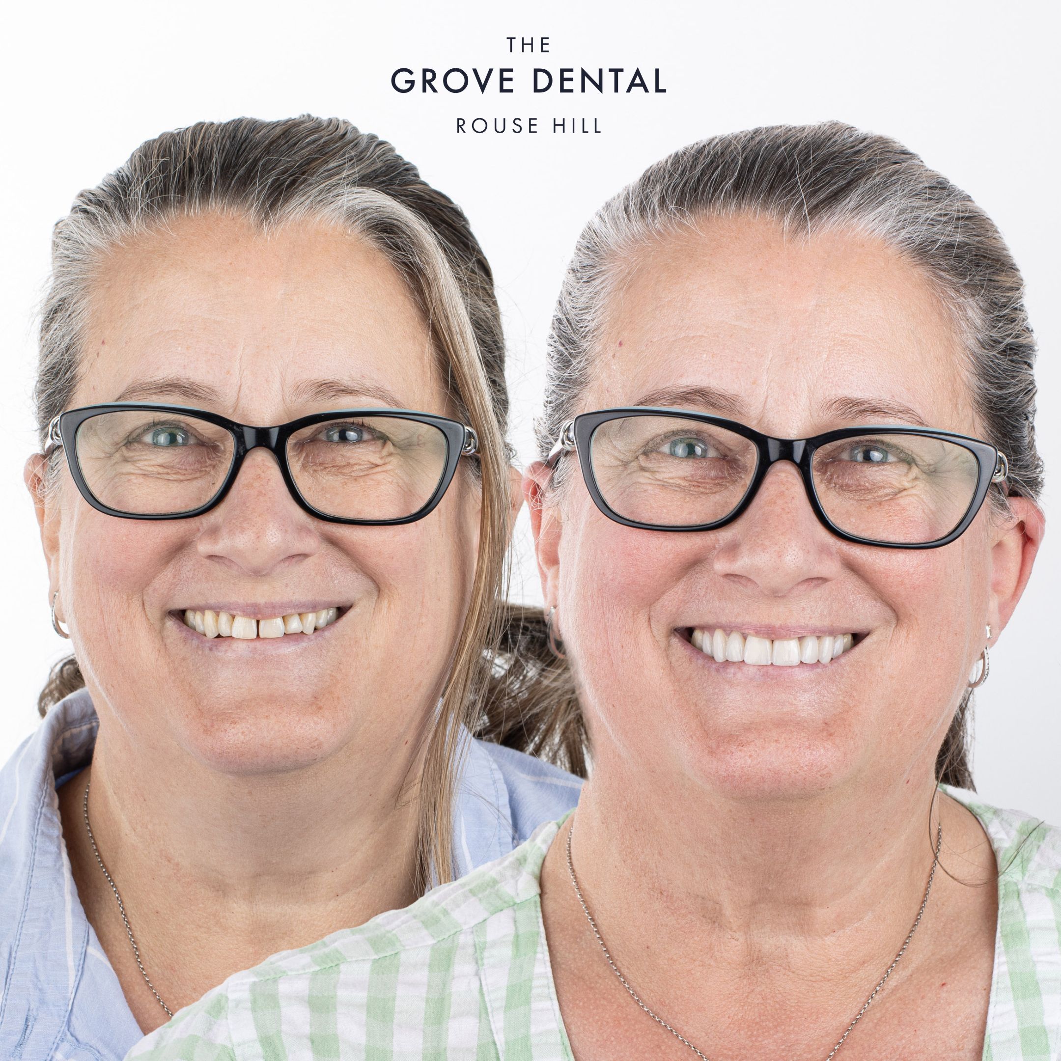 Clear aligner smile alignment — patient portrait at The Grove Dental